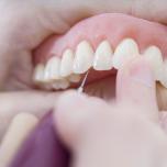 Impianto dentale completo