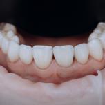 Impianto dentale fisso