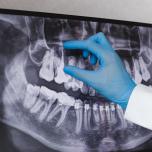 Impianto dentale quando manca l'osso