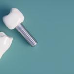 Impianto dentale tempi