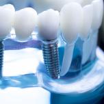 Implantologia dentale a carico immediato
