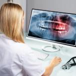 Implantologia dentale arcata inferiore