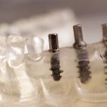 Implantologia dentale prezzi