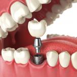 Infezione impianto dentale sintomi