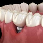Perimplantite immagini