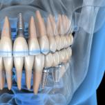 Quanti impianti dentali si possono fare in una seduta