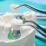 Rigetto impianto dentale