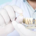 Rischi Impianto Dentale
