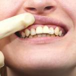 Sintomi impianto dentale fallito