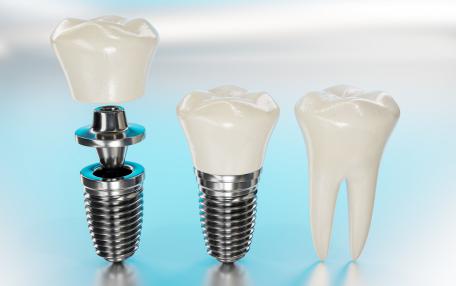 Denti fissi in titanio