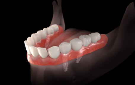 Denti fissi su 4 impianti