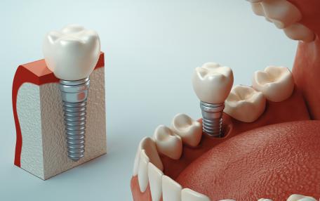 Denti impianto