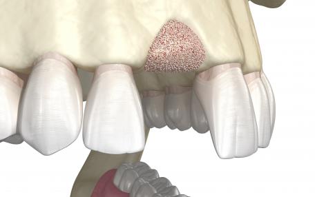 Estrazione dente e impianto costo
