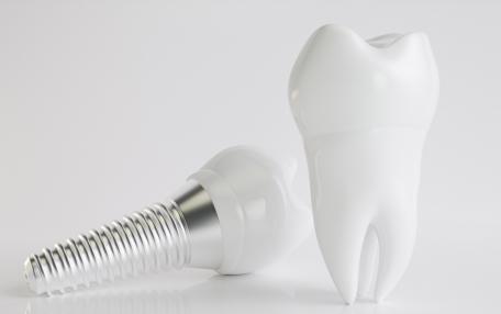 Impianto dentale fisso