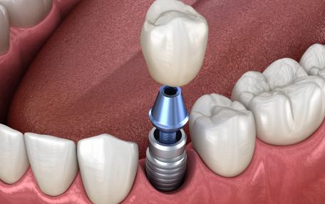 Impianto dentale garanzia