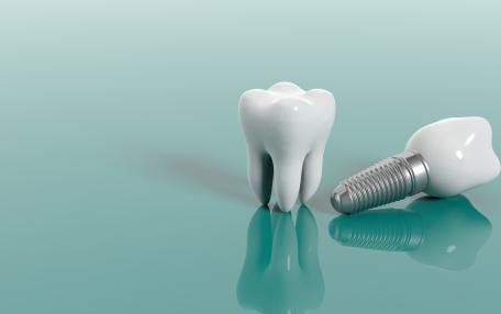 Impianto dentale molare