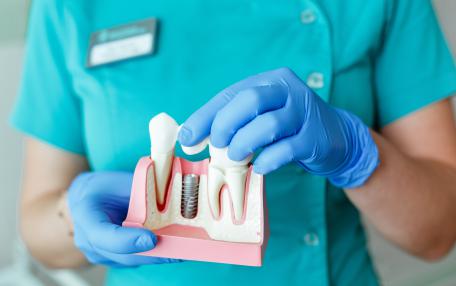 Migliori impianti dentali
