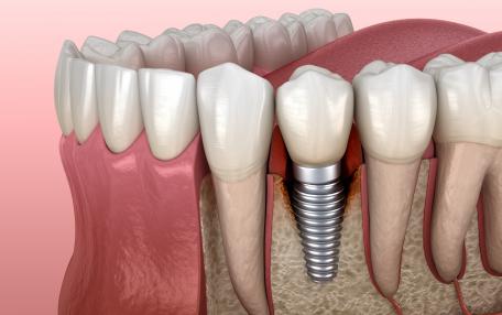 Perimplantite immagini
