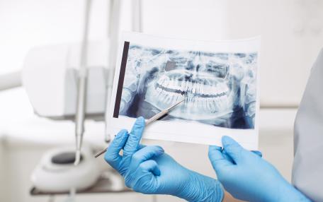 Quando non si può fare un impianto dentale