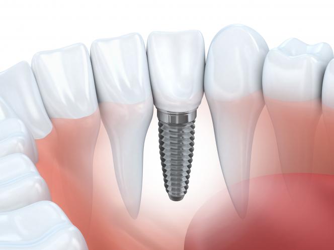 Costo impianto dentale Croazia Costo impianto dentale Croazia