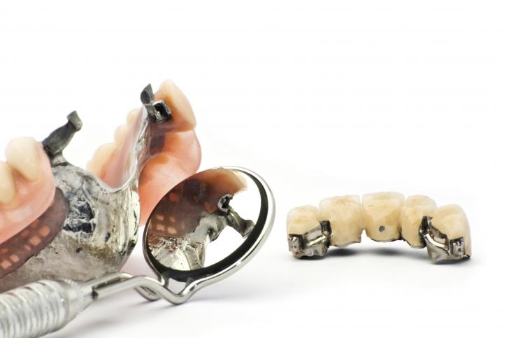 Costo impianto dentale Costo impianto dentale