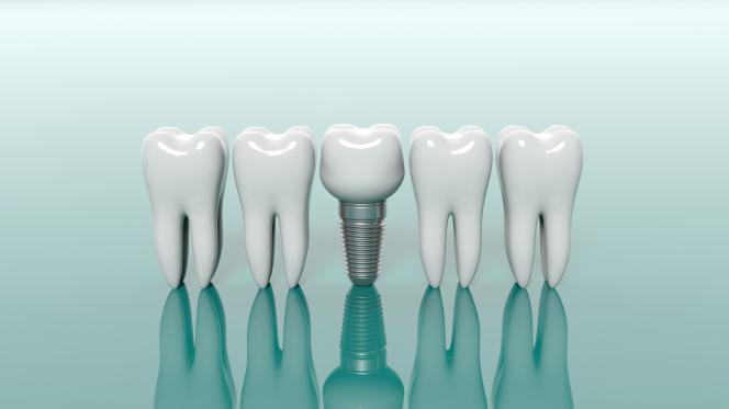 Denti impianto Denti impianto