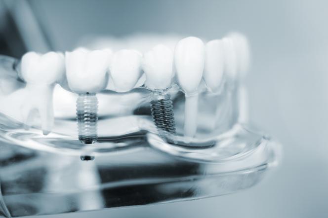 Impianti dentali gratis Impianti dentali gratis