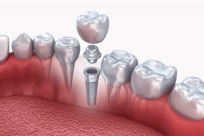 Gli impianti dentali Gli impianti dentali