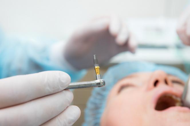 Impianto dentale 4 denti Impianto dentale 4 denti