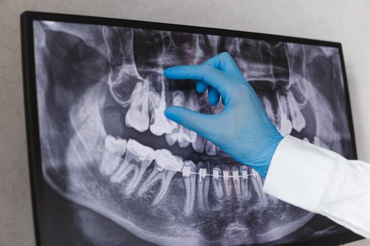 Impianto dentale quando manca l'osso Impianto dentale quando manca l'osso