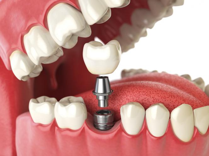 Infezione impianto dentale sintomi Infezione impianto dentale sintomi