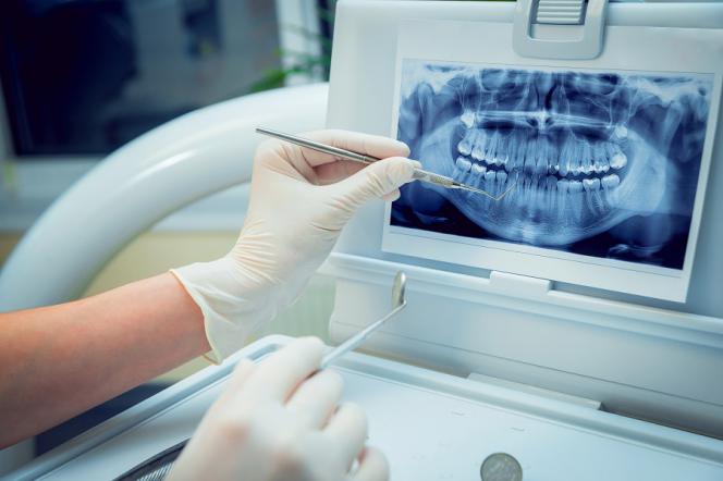 Perimplantite Perimplantite