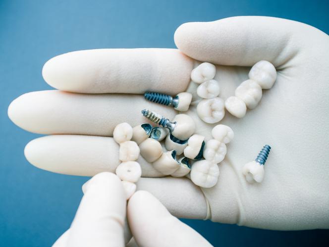 Ricostruzione dente devitalizzazione con perno costo Ricostruzione dente devitalizzazione con perno costo