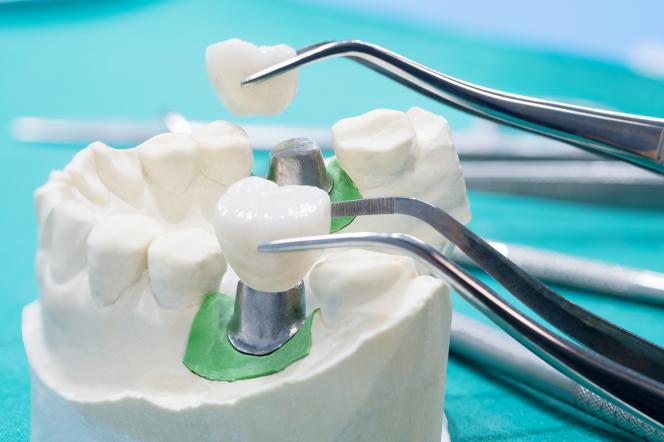 Rigetto impianto dentale Rigetto impianto dentale