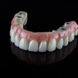 Fa male mettere un ponte dentale