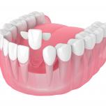 Maryland dente provvisorio