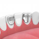 Maryland denti si stacca