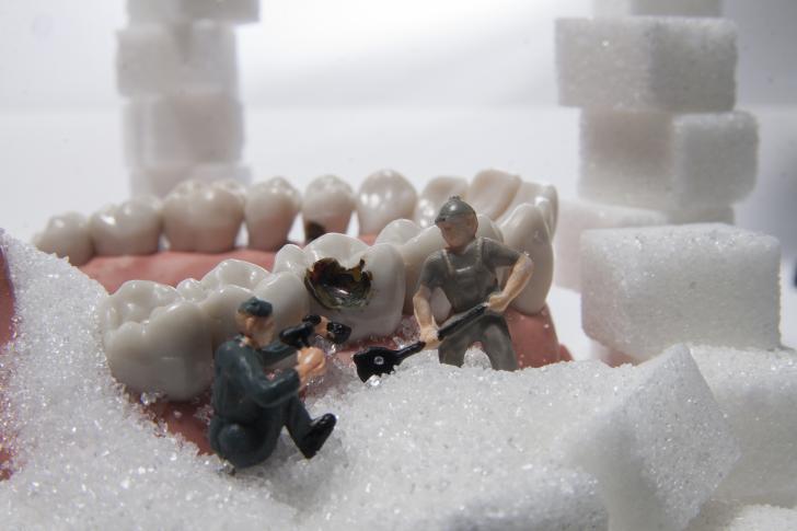 Come togliere un ponte dentale Come togliere un ponte dentale