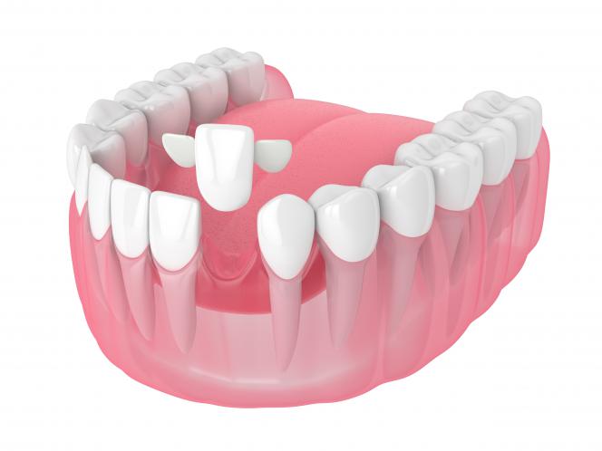 Maryland dente provvisorio Maryland dente provvisorio
