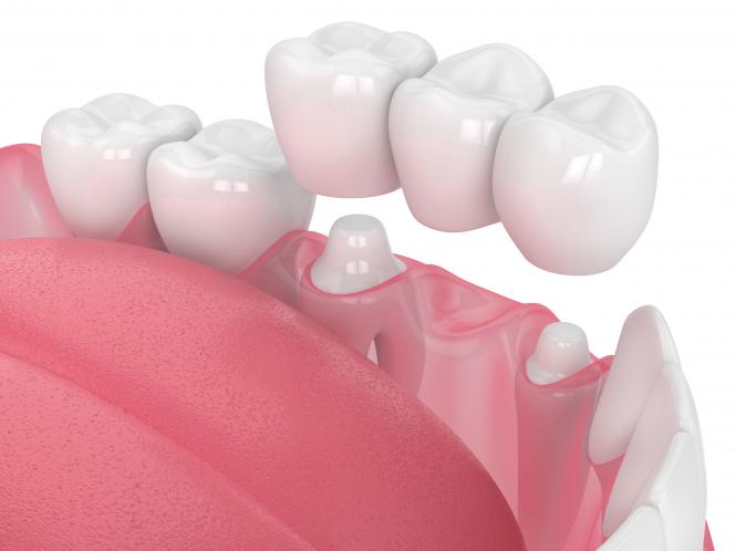 Ponte dentale quanto dura Ponte dentale quanto dura