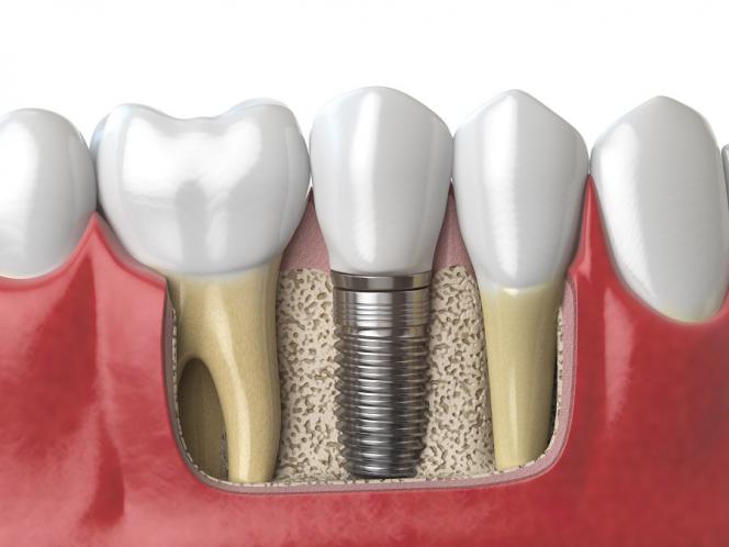 Ponte o impianto dentale costi Ponte o impianto dentale costi