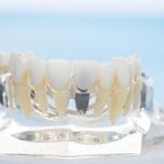 Impianti dentali in Croazia opinioni