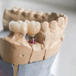 Impianti dentali prezzi in Romania