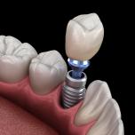 Impianti dentali Ungheria