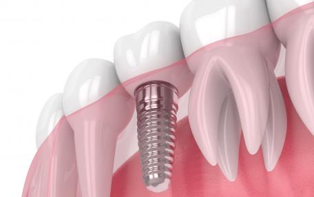 Impianti dentali Ungheria