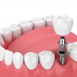 Implantologia dentale Firenze
