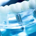 Implantologia dentale Messina