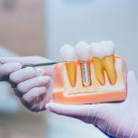 Implantologia dentale Trieste