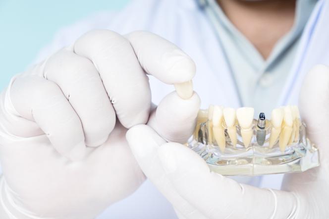 Implantologia dentale Padova Implantologia dentale Padova