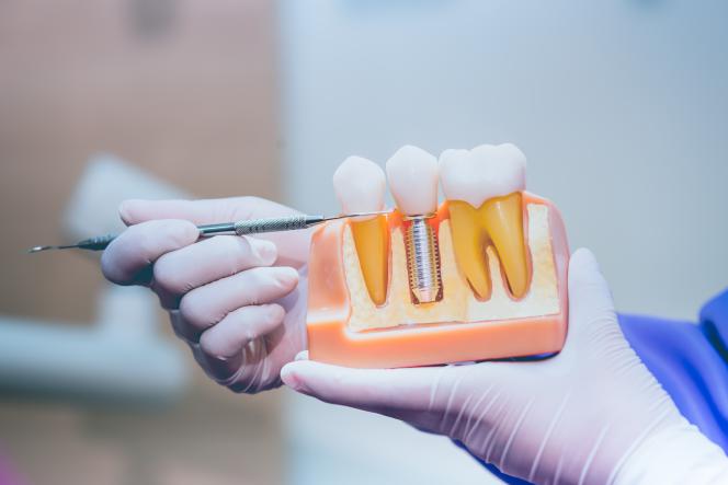 Implantologia dentale Trieste Implantologia dentale Trieste